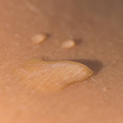 urticaire chronique spontanée ou cholinergique maladie de peau et approche du terrain en naturopathie pour confort et vitalité. Naturopathie de la peau Gertwiller Andlau Visio Selestat Colmar Obernai Mulhouse Alsace Mutzig Molsheim