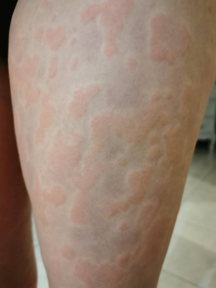 Barbara Herrbach, naturopathe près d'Obernai et Barr, spécialisée dans l'accompagnement de l'urticaire chronique